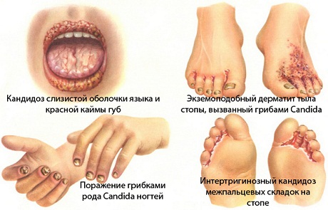 Кандидоз (молочница) у детей