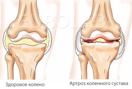 Артроз колена