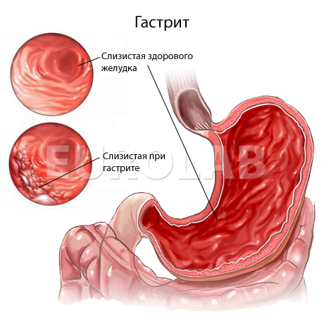 гастирит