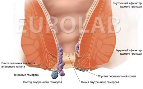 геморрой