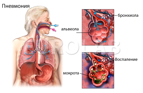 Болезнь пневмония