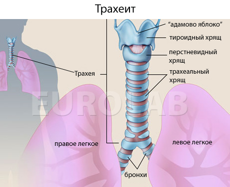 трахеит