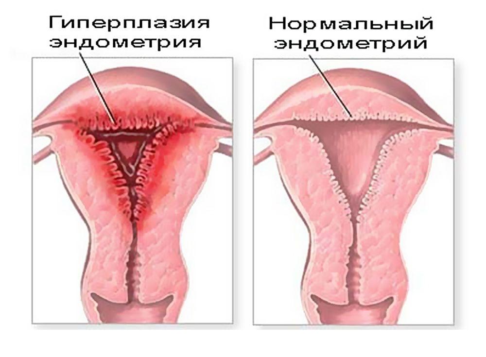 Гиперплазия эндометрия 