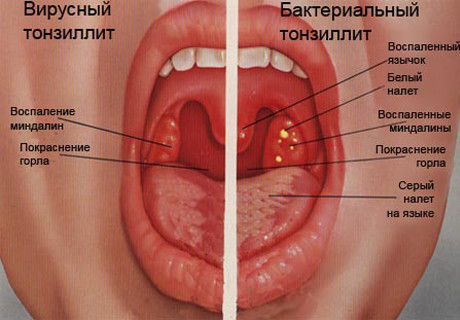 тонзиллит