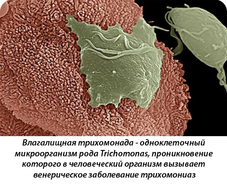 Половой трихомониаз