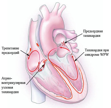 Желудочковая тахикардия