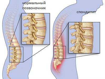 Спондилит