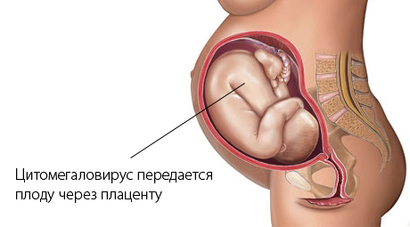цвм-инфекция у младенца