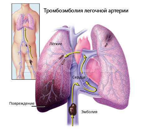 тромбоэмболия легочной артерии