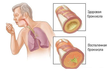 воспаленная бронхиола