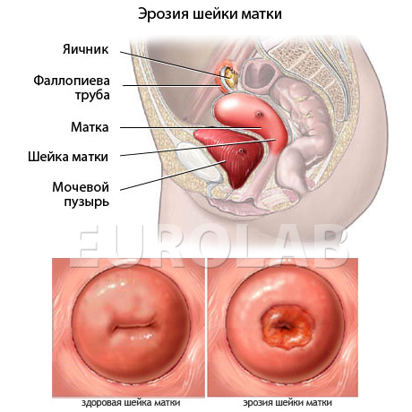 эрозия шейки матки