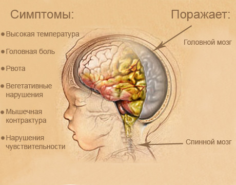 Менингит