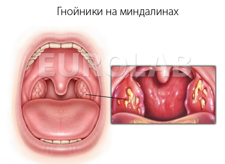 гнойники на миндалинах