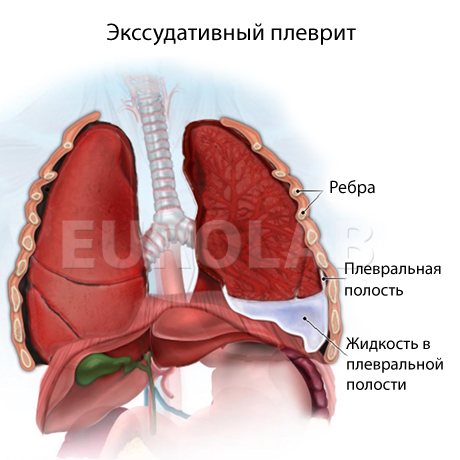 плеврит