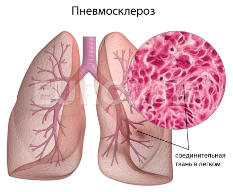 пневмосклероз