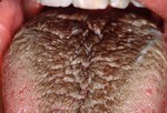 «Черный волосатый» язык.
Нет, это не из области фантастики. «Черный волосатый» язык возникает, когда маленькие шишки на языке развиваются и растут (вместо отмирания), а соответственно в них развиваются бактерии. К этому может привести плохая гигиена рта, некоторые ополаскиватели рта и антибиотики. Чтобы это не было, нужно чистить зубы и язык дважды в день, полоскать рот смесью одной части пероксид водорода и пяти частей воды, а также пользоваться скребком для языка.