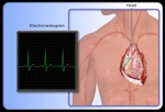 Что такое электрокардиограмма (ЭКГ)?
Здоровое сердце работает как «электрический насос» и нуждается в сильном притоке крови, для обеспечения организма «электричеством». У людей же с заболеваниями сердца приток крови слабый, поэтому сердце обеспечивает организм «электричеством» плохо. Электрокардиограмма (ЭКГ) – неразрушающий (безвредный) анализ, при котором измеряется электрическая активность сердца. ЭКГ занимает около 5 минут и это абсолютно безболезненная процедура. Кроме того, с помощью ЭКГ могут быть обнаружены и симптомы других нарушениях работы сердца, например:
•	Анормальные сердечные ритмы.
•	Признаки прошедшего сердечного приступа.
•	Признаки надвигающегося сердечного приступа.
•	Нестабильная стенокардия.
•	Врожденный порок сердца.
•	Признаки ненормального состояния электролитов в крови.
•	Признак воспалительных процессов в сердце (миокардит, перикардит).