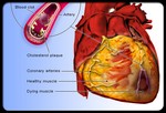 Связь между заболеваниями сердца и сердечным приступом.
Бляшки в артериях вызывают образование сгустков крови в коронарной артерии. Кровяные сгустки не дают крови поступать к сердечной мышце, что и приводит к сердечному приступу. В худшем случае происходит остановка сердца или нарушение ритма несовместимое с жизнью.