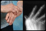 Диагностический тест: рентген суставов.
На ранней стадии болезни результаты рентгена суставов могут быть нормальными или же показать небольшую опухоль мягких тканей. Когда болезнь прогрессирует, на рентгене можно увидеть эрозию костей, которая характерна для ревматоидного артрита. Рентген суставов может помочь в наблюдении за развитием болезни и повреждением суставов. А сканирование костей, радиоактивная методика обследования, и МРТ может помочь определить воспаленные или пораженные эрозией суставы.