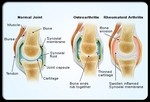 Какая разница между здоровыми суставами и суставами, пораженными артритом?
Сустав – это соединение двух костей, которое позволяет двигаться всем частям тела. Артрит – это воспаление сустава. Воспаление сустава при ревматоидном артрите сопровождается опуханием, болью, тугоподвижностью и покраснением суставов. Воспаление при ревматоидной болезни может поражать и ткани вокруг сустава, например, сухожилия, связки и мышцы. У некоторых больных ревматоидным артритом хроническое воспаление заканчивается разрушением хрящей, костей и сухожилий, что вызывает деформацию суставов. Разрушение суставов может произойти и на ранней стадии болезни.