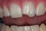 Выкрашивание зуба.
Жевание льда или твердых леденцов, скрежетание или стискивание зубов, а также их подвергание резкому перепаду температуры приводит к образованию трещин и дальнейшему их разрушению. Микротрещины на начальном этапе могут не вызывать болезненных ощущений, но со временем появляются более серьезные проблемы. В этом случае стоматолог порекомендует адгезионную фиксацию, наращивание и металлокерамику.