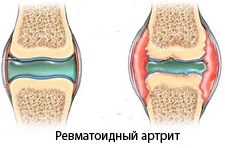ревматоидный артрит