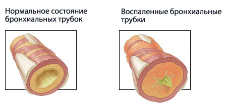 бронхиальная астма 