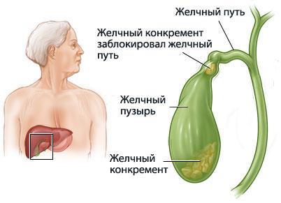 Камни в желчном пузыре