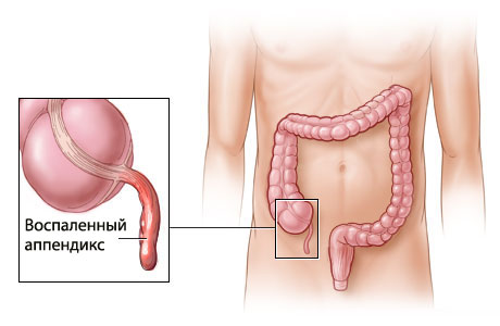 аппендицит