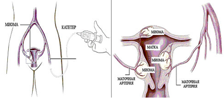 миома